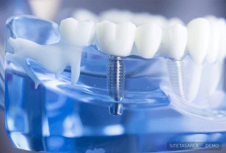 Diş implantını anlatan örnek dental model fotoğrafı